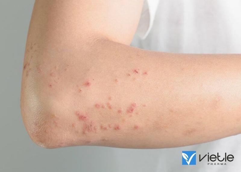 DỊ ỨNG THUỐC LÀ GÌ, TRIỆU CHỨNG VÀ ĐIỀU TRỊ