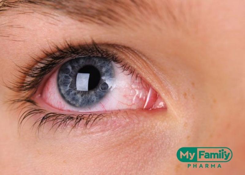 ĐỎ MẮT: NGUYÊN NHÂN, ĐIỀU TRỊ VÀ PHÒNG NGỪA