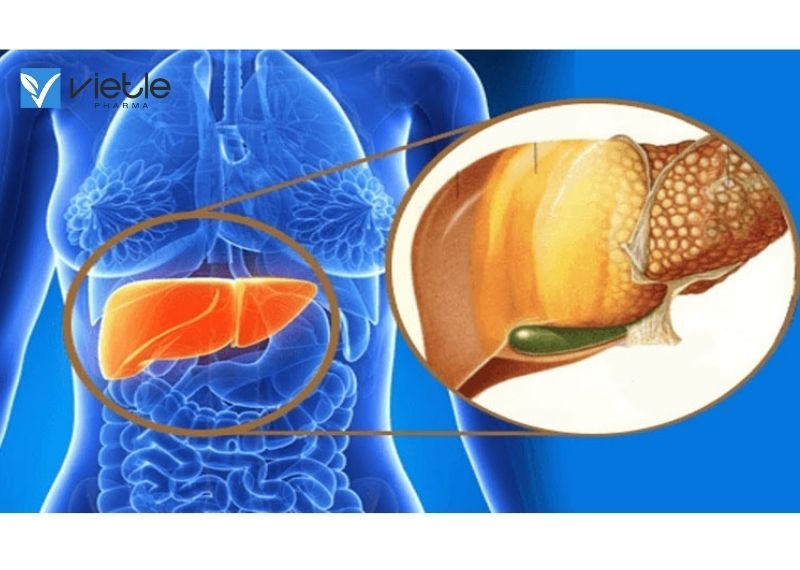 GAN NHIỄM MỠ LÀ GÌ? NGUYÊN NHÂN VÀ CÁCH ĐIỀU TRỊ