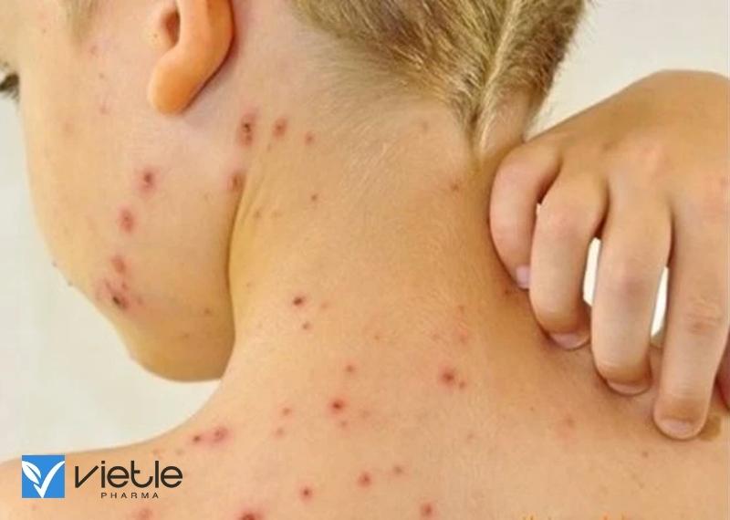 GHẺ CÓC LÀ GÌ? NGUYÊN NHÂN VÀ HƯỚNG ĐIỀU TRỊ