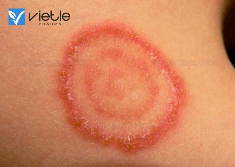 HẮC LÀO LÀ GÌ, NGUYÊN NHÂN, TRIỆU CHỨNG VÀ ĐIỀU TRỊ