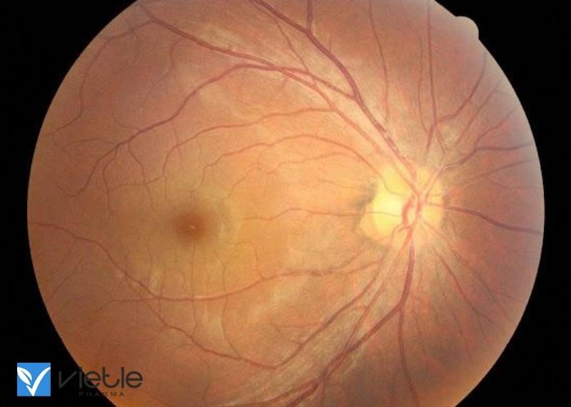 HẮC VÕNG MẠC TRUNG TÂM LÀ GÌ VÀ ĐIỀU TRỊ