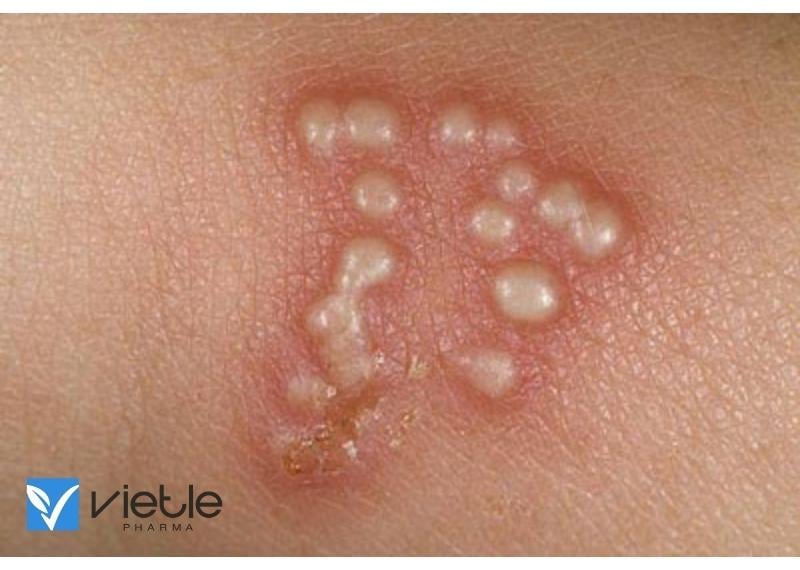 HERPES SINH DỤC VÀ NHỮNG ĐIỀU CẦN BIẾT