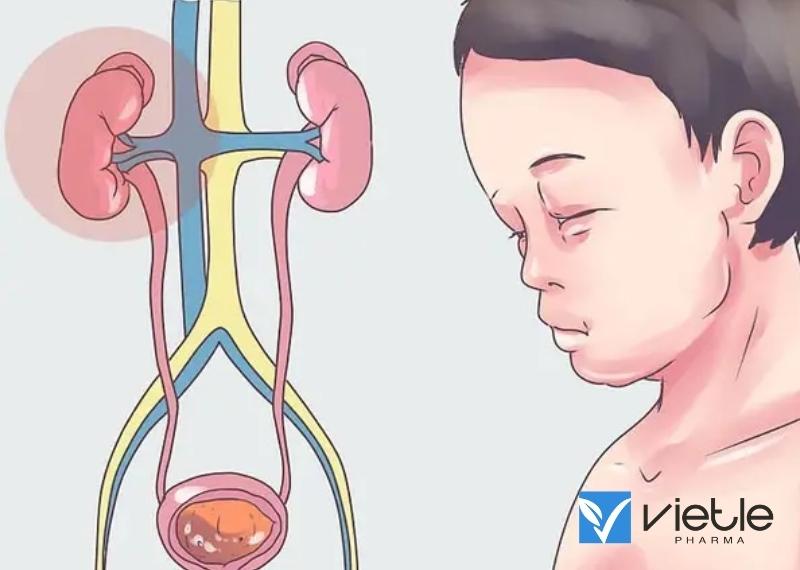HỘI CHỨNG THẬN HƯ TIÊN PHÁT Ở TRẺ EM VÀ NHỮNG ĐIỀU CẦN BIẾT