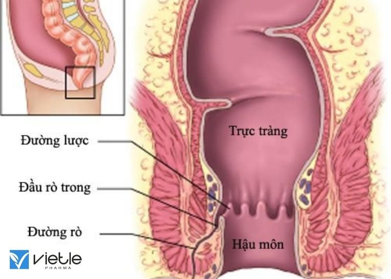 KHE NỨT VÀ LỖ RÒ HẬU MÔN, NHỮNG THÔNG TIN CẦN BIẾT