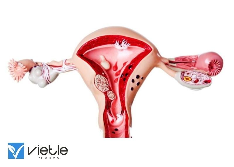 LẠC NỘI MẠC TỬ CUNG VÀ NHỮNG ĐIỀU CẦN BIẾT