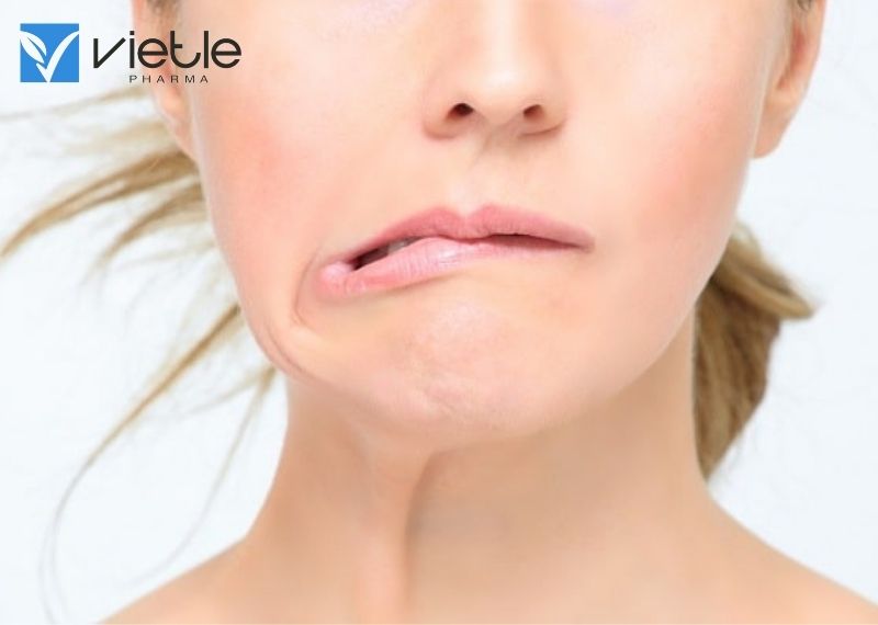LIỆT MẶT NGOẠI BIÊN LÀ GÌ?