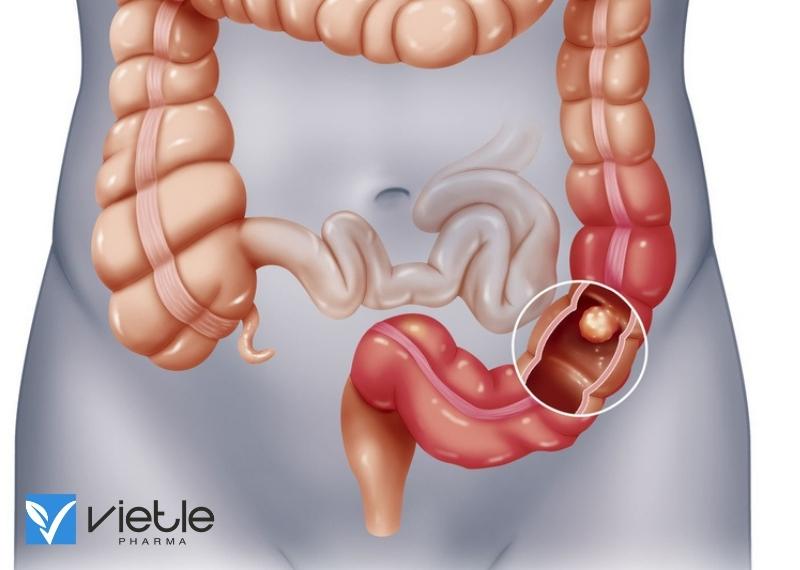 LỒNG RUỘT LÀ GÌ? NGUYÊN NHÂN, TRIỆU CHỨNG VÀ CÁCH ĐIỀU TRỊ