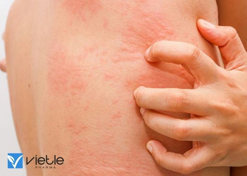 MỀ ĐAY LÀ GÌ? TRIỆU CHỨNG VÀ HƯỚNG DẪN ĐIỀU TRỊ