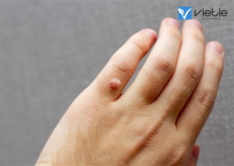 MỤN CÓC, HẠT CƠM LÀ GÌ? HƯỚNG DẪN ĐIỀU TRỊ