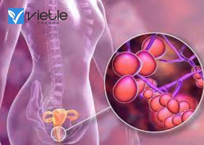 Nấm âm đạo - nguyên nhân và cách điều trị