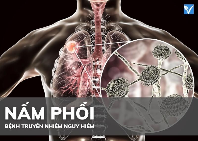 NẤM PHỔI - BỆNH TRUYỀN NHIỄM ĐƯỜNG HÔ HẤP NGUY HIỂM
