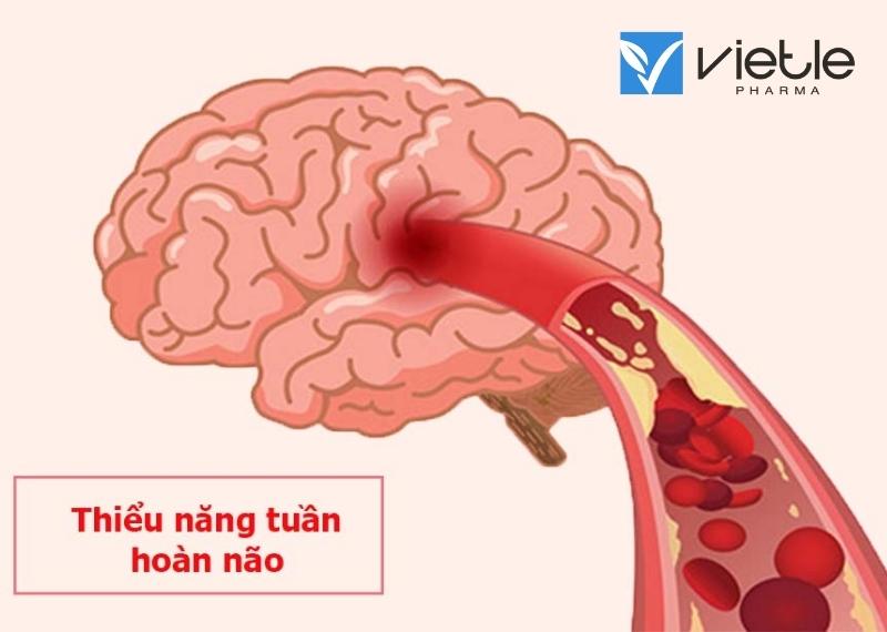 THIỂU NĂNG TUẦN HOÀN NÃO LÀ GÌ? TRIỆU CHỨNG VÀ CÁCH ĐIỀU TRỊ