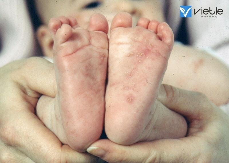NHIỄM KÍ SINH TRÙNG ĐƯỜNG RUỘT Ở TRẺ EM
