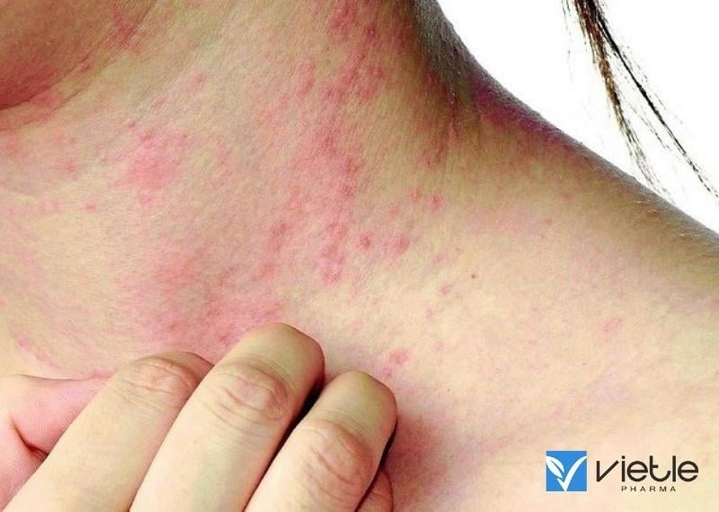 NHIỄM SÁN MÁNG: NGUYÊN NHÂN, TRIỆU CHỨNG VÀ ĐIỀU TRỊ