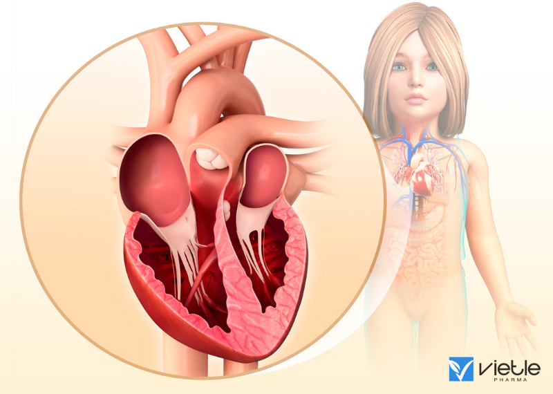 PHÌ ĐẠI THẤT TRÁI: NGUYÊN NHÂN, TRIỆU CHỨNG VÀ HƯỚNG ĐIỀU TRỊ