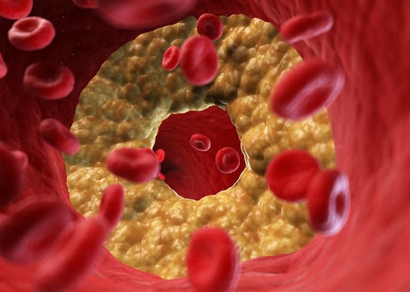 Rối loạn lipid máu - căn bệnh nguy hiểm hàng triệu người mắc phải