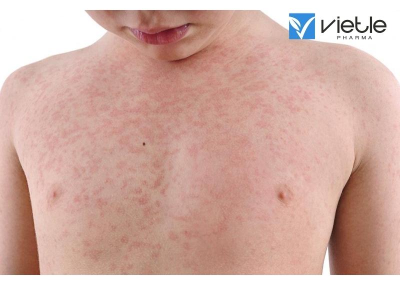 NHỮNG ĐIỀU CẦN BIẾT VỀ RUBELLA