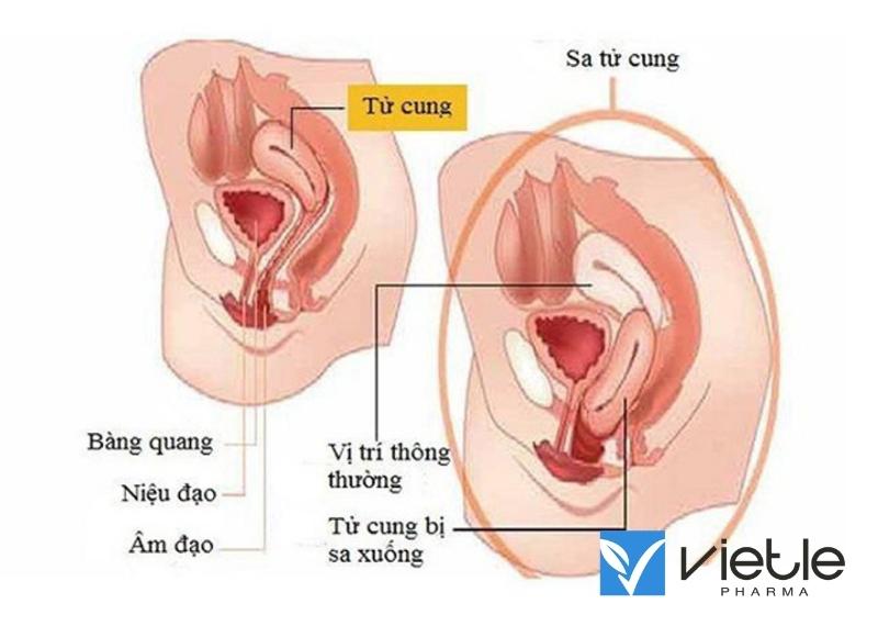 Sa sinh dục là gì, có nguy hiểm không?
