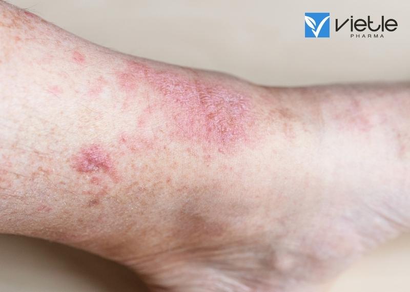 SẨN NGỨA: NGUYÊN NHÂN VÀ CÁCH ĐIỀU TRỊ