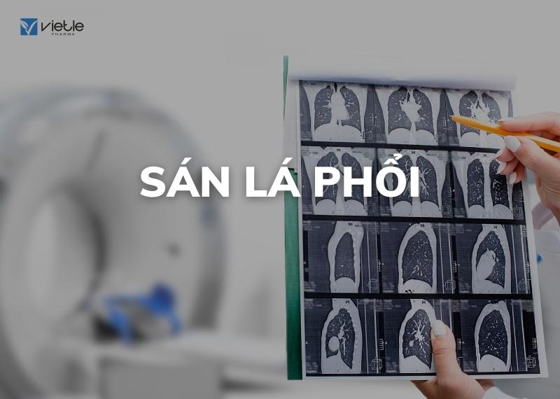 SÁN LÁ PHỔI - CHẨN ĐOÁN VÀ CÁCH ĐIỀU TRỊ