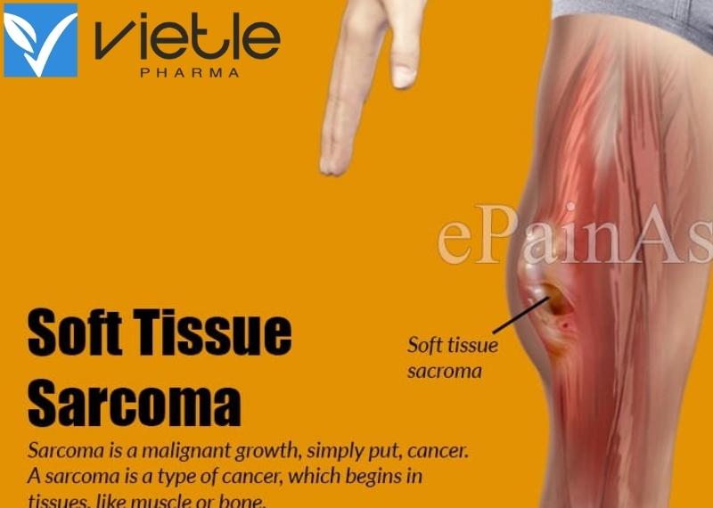 Sarcoma mô mềm
