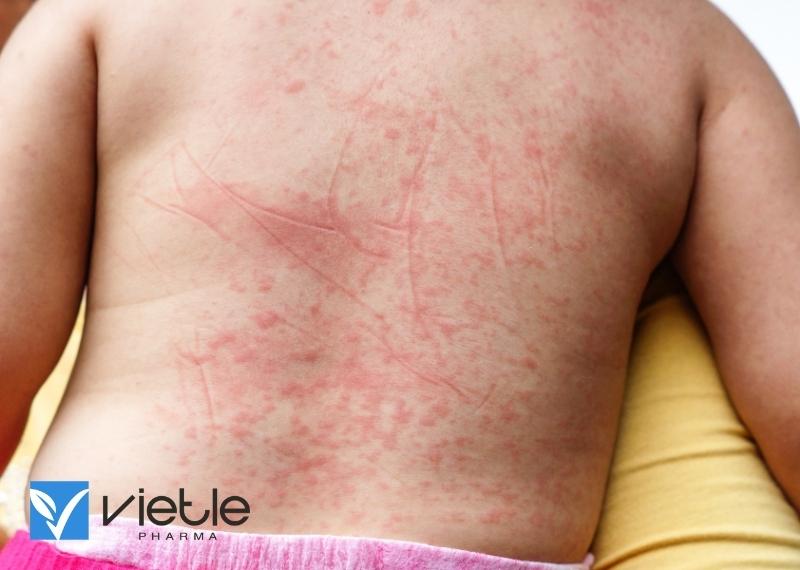 SỐT XUẤT HUYẾT DENGUE: CHẨN ĐOÁN VÀ ĐIỀU TRỊ