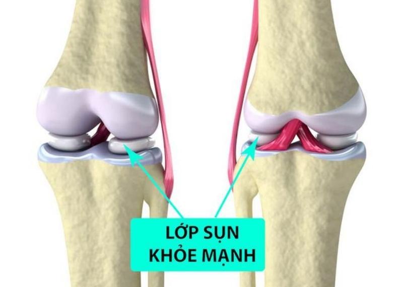 Sụn xương có tác dụng gì, làm thế nào để bảo vệ?