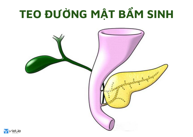 TEO ĐƯỜNG MẬT BẨM SINH
