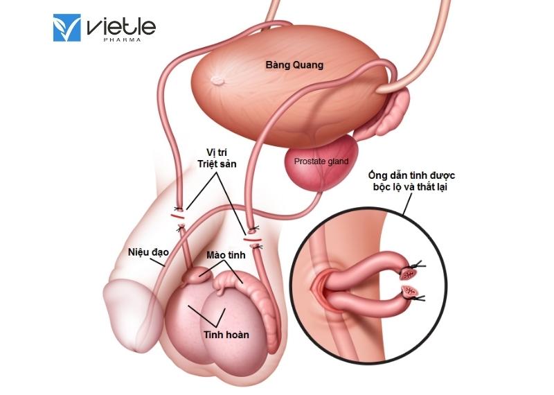 THẮT ỐNG DẪN TINH VÀ NHỮNG ĐIỀU CẦN BIẾT