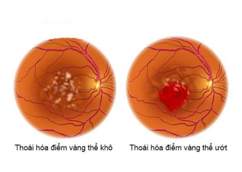 THOÁI HÓA ĐIỂM VÀNG: DẤU HIỆU VÀ TRIỆU CHỨNG
