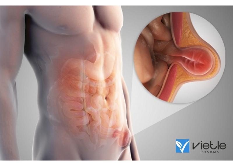 THOÁT VỊ ĐÙI VÀ NHỮNG ĐIỀU CẦN BIẾT