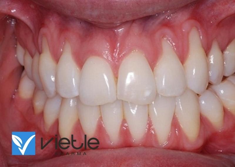 Tụt lợi - nguyên nhân và cách khắc phục