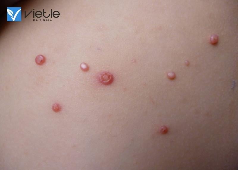 U MỀM LÂY LÀ GÌ, BIỂU HIỆN VÀ HƯỚNG ĐIỀU TRỊ