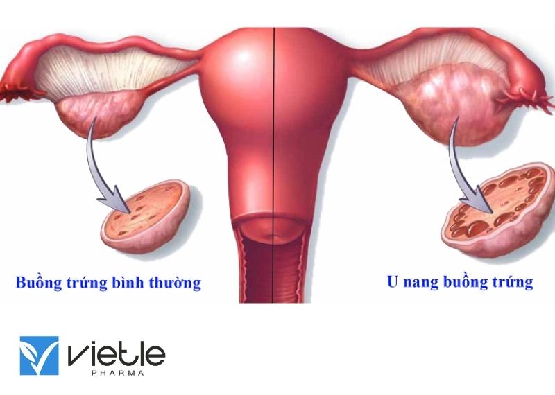 U NANG BUỒNG TRỨNG VÀ NHỮNG ĐIỀU CẦN BIẾT