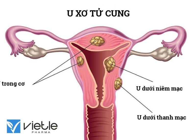 U xơ tử cung - Nguyên nhân và cách điều trị