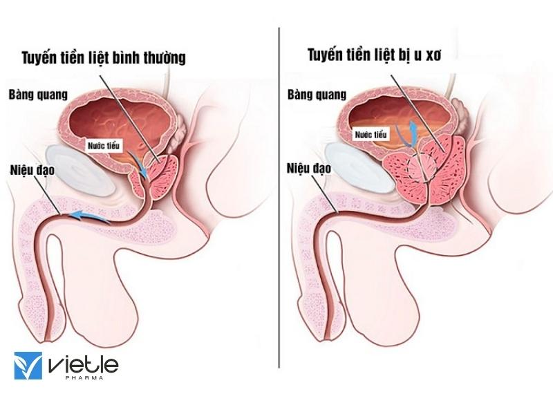 U XƠ TUYẾN TIỀN LIỆT LÀ GÌ?