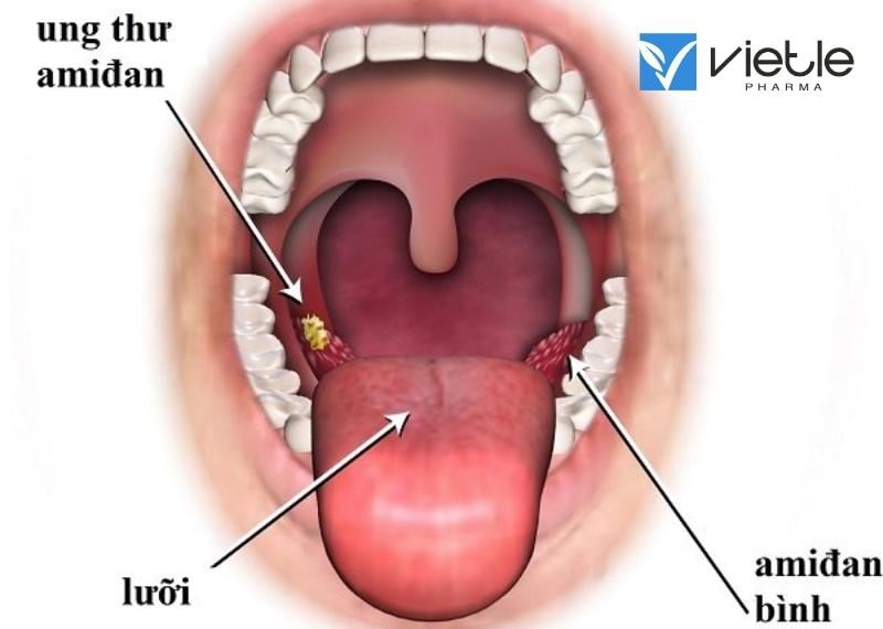 UNG THƯ AMIDAN: CHẨN ĐOÁN VÀ ĐIỀU TRỊ