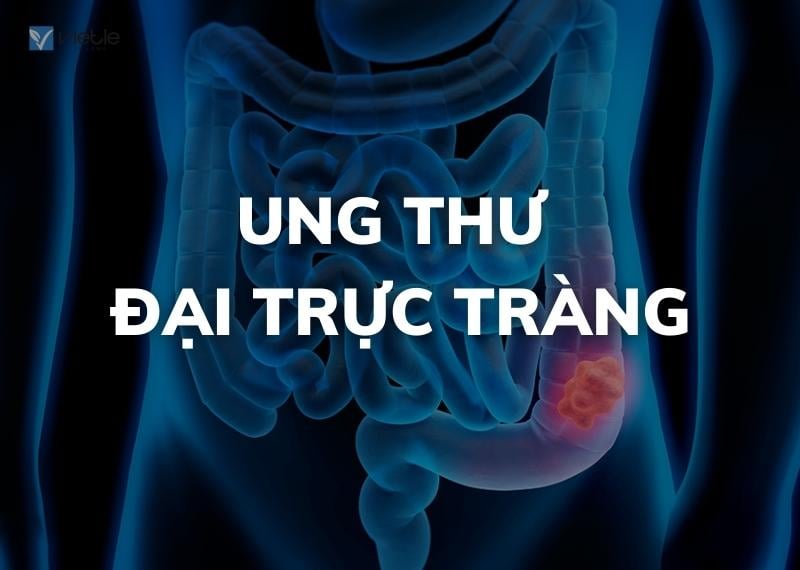 UNG THƯ ĐẠI TRỰC TRÀNG -TỔNG QUAN VÀ TẦM SOÁT PHÁT HIỆN SỚM