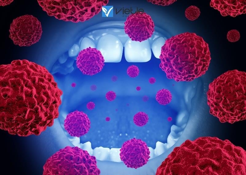 Bệnh ung thư khoang miệng cần điều trị như thế nào?