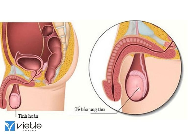 UNG THƯ TINH HOÀN VÀ NHỮNG ĐIỀU CẦN BIẾT