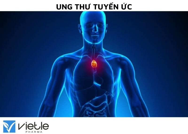 UNG THƯ TUYẾN ỨC VÀ NHỮNG ĐIỀU CẦN BIẾT