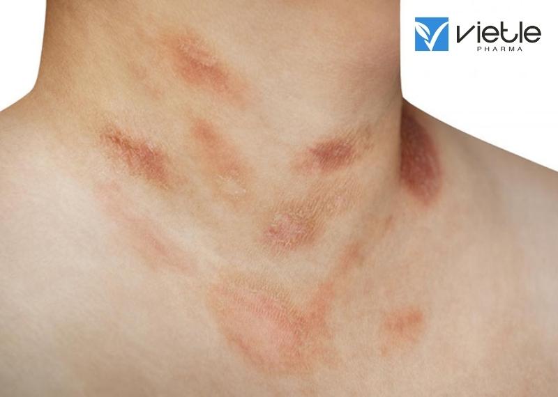 VẢY PHẤN HỒNG GIBERT VÀ NHỮNG THÔNG TIN CẦN BIẾT