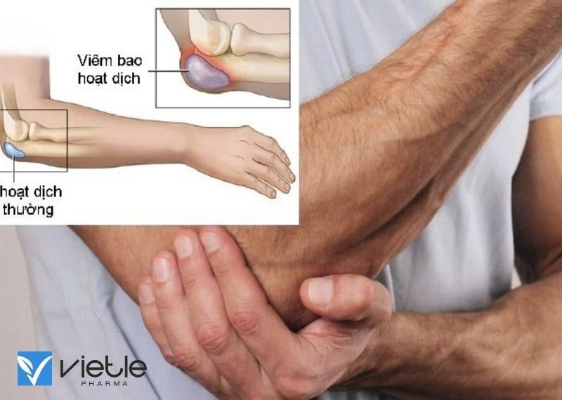 Viêm bao hoạt dịch là gì - Nguyên nhân và cách điều trị