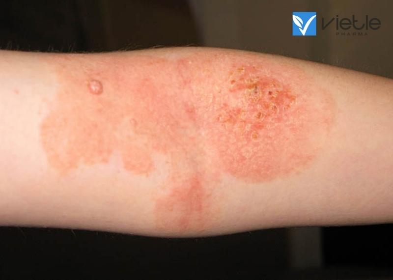 VIÊM DA DO ÁNH NẮNG VÀ HƯỚNG DẪN ĐIỀU TRỊ