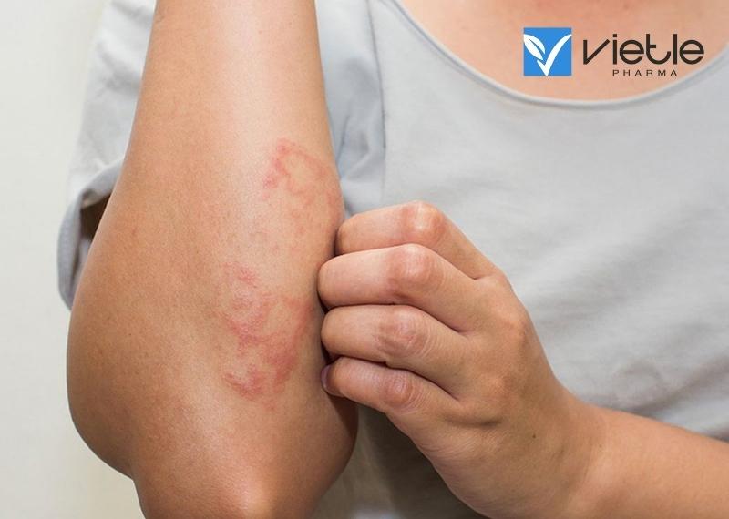 VIÊM DA DO TIẾP XÚC LÀ GÌ, NGUYÊN NHÂN VÀ ĐIỀU TRỊ