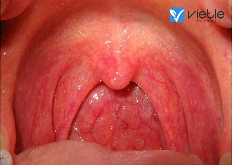 Một số hiểu biết về viêm họng mạn tính và hướng dẫn điều trị