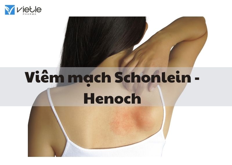 Viêm mạch Schonlein - Henoch