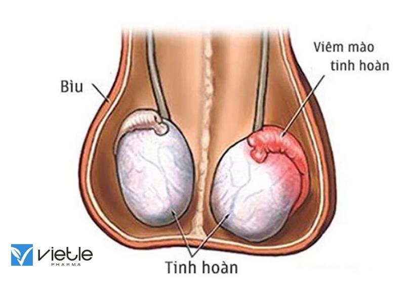 VIÊM TINH HOÀN VÀ NHỮNG ĐIỀU CẦN BIẾT