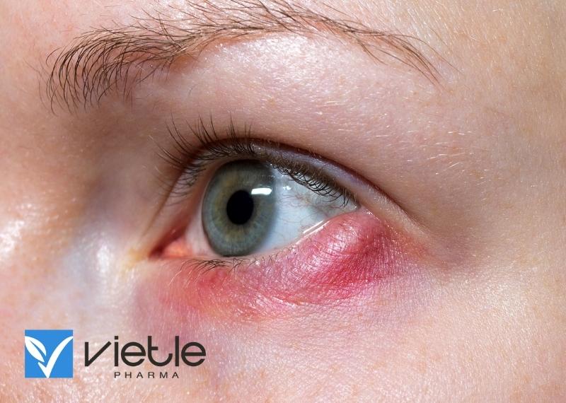 Viêm tổ chức hốc mắt